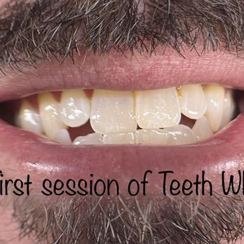 Evolve Beauty Bar - Teeth whitening before - Skin Care Near Me - Highlands Ranch, Colorado Evolve Beauty Bar - Teeth whitening before - Skin Care Near Me - Highlands Ranch, Colorado