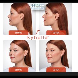 Dermatology And Skin Cancer Center - Kybella - no more turkey neck.