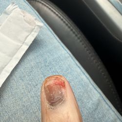 2000 Nails - Left bleeding with part of natural nail ripped off. Told to come back in 3-5 days.