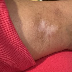 Mississippi Vein Institute - Fully Healed leg ulcer.