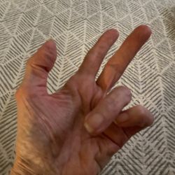Tucson Orthopedic Institute - My left hand after a failed trigger finger procedure.