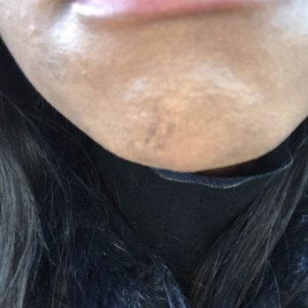 Lush Nail Bar - Multiple scars on chin following chin wax - Nail Salons Near Me - East Point, Georgia Lush Nail Bar - Multiple scars on chin following chin wax - Nail Salons Near Me - East Point, Georgia
