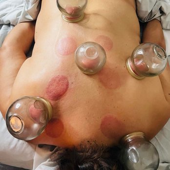 A & A Therapeutic Massage - Cupping therapy can help reduce stress and pain, and is also a great therapy for athletes. - Massage Therapy Near Me - Bolingbrook, Illinois A & A Therapeutic Massage - Cupping therapy can help reduce stress and pain, and is also a great therapy for athletes. - Massage Therapy Near Me - Bolingbrook, Illinois