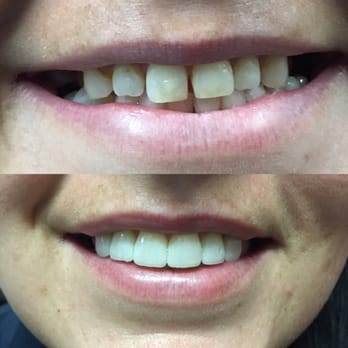 Burre Dental Center - Before and After - General Dentistry Near Me - Eureka, California Burre Dental Center - Before and After - General Dentistry Near Me - Eureka, California