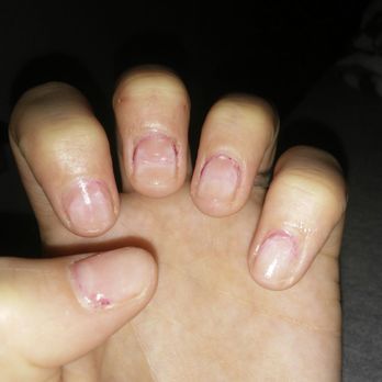 Nails Now - This is after nail removal, and after I spent more money on nail strengthener. - Nail Salons Near Me - Springfield, Oregon