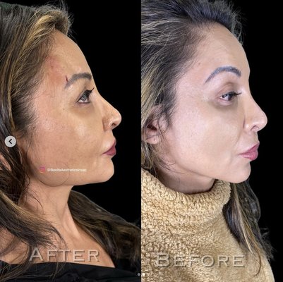 Face Lifts and Contouring - Face, eye and cheek lifts