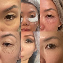 Heavenly Aesthetics - 8 days from before to after procedure. No bags!
