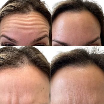 BioLift Med Spa - Fore head correction tox - Acne Treatment Near Me - Boynton Beach, Florida BioLift Med Spa - Fore head correction tox - Acne Treatment Near Me - Boynton Beach, Florida