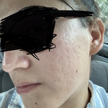 Solutions Skin Care By Kimberly - after first visit - Skin Care Near Me - Costa Mesa, California