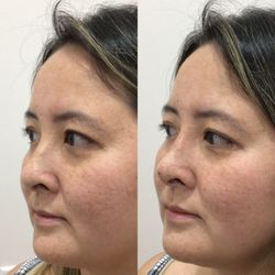 XO Medical Spa - PDO threads nose