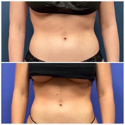 Advanced Body Sculpting Institute - My abdomen is tighter and more defined following Emsculpt. (Top image - Before Emsculpt. Bottom Image - After)