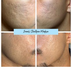 Irene's Skintopia - Before and After Scarlet Radio Frequency Micro-Needling with PRP 3 sessions.