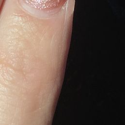 Brand new fill after I left. All fingers looked like this. Looks like a week or two growth.