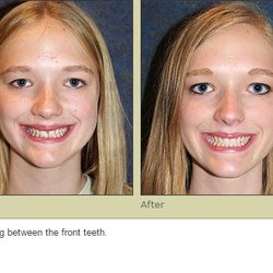 Seattle Dental Associates - Invisalign Results