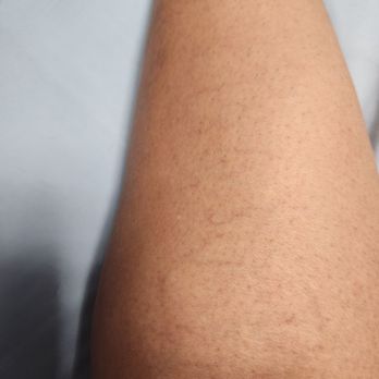 USA Vein Clinics - My spider veins problem - Vascular Medicine Near Me - Hallandale Beach, Florida USA Vein Clinics - My spider veins problem - Vascular Medicine Near Me - Hallandale Beach, Florida