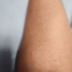 USA Vein Clinics - My spider veins problem
