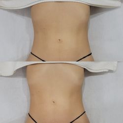 Bodyby_emilyg - Brazilian Lymphatic Drainage