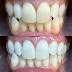 Pearl Teeth Whitening - My Epic Results!