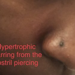 Skinhibitions - Nose piercing scarring