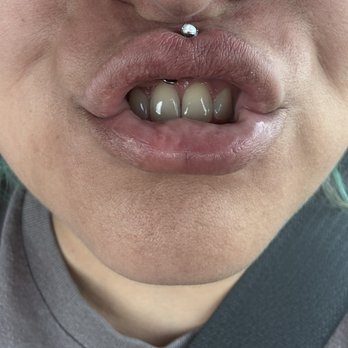 Lilac Tattoo Studio - Philtrum -crooked - Tattoo Near Me - Dallas, Texas