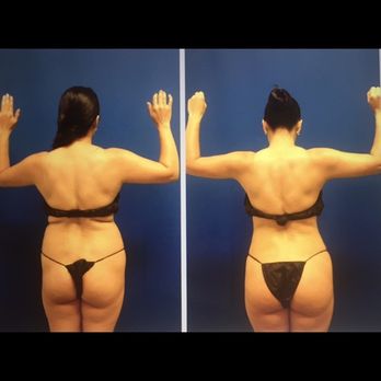 Mats Hagstrom, MD - Brazilian Butt Lift. Gluteal fat transfer - Cosmetic Surgeons Near Me - Roseville, California Mats Hagstrom, MD - Brazilian Butt Lift. Gluteal fat transfer - Cosmetic Surgeons Near Me - Roseville, California