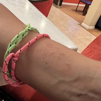 Best Western Webster Hotel, NASA - Bites and rash from sleeping at the hotel - Hotels Near Me - Webster, Texas Best Western Webster Hotel, NASA - Bites and rash from sleeping at the hotel - Hotels Near Me - Webster, Texas