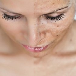 The Aesthetics Lounge and Spa Raleigh - IPL - Treats a variety of skin conditions, including skin discoloration, broken capillaries, age spots, sun-induced freckles and rosacea.
