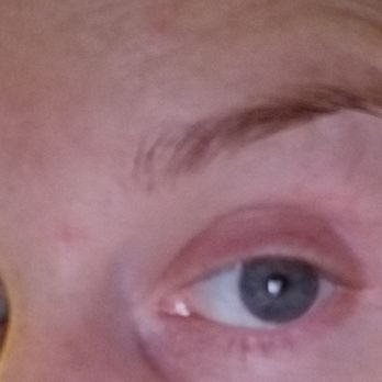 Advanced Cosmetic Surgery, Dr. Levi J. Young - Drooping of the eye and the roll left by injector error - Cosmetic Surgeons Near Me - Leawood, Kansas Advanced Cosmetic Surgery, Dr. Levi J. Young - Drooping of the eye and the roll left by injector error - Cosmetic Surgeons Near Me - Leawood, Kansas