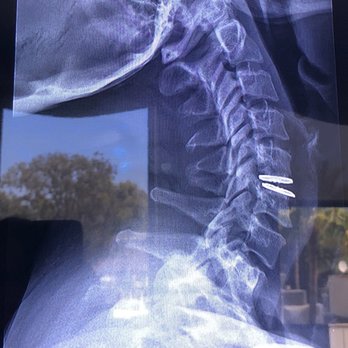 Lanman H Todd, MD - Lanman Spinal Neurosurgery - 4 years later - Spine Surgeons Near Me - Beverly Hills, California