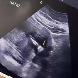 Bun In The Oven Imaging - Hand