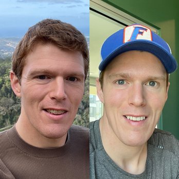 Flash Dentspa - Left before Morpheus8, Right is ~2months after 3rd session - Cosmetic Dentists Near Me - St. Petersburg, Florida Flash Dentspa - Left before Morpheus8, Right is ~2months after 3rd session - Cosmetic Dentists Near Me - St. Petersburg, Florida