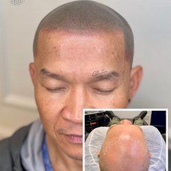 Scalp MicroPigmentation of California