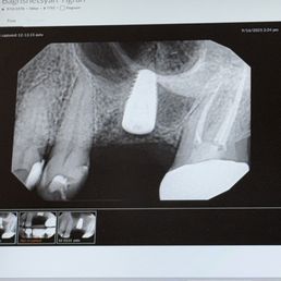 They did an amazing job with my implant. They did an amazing job with my implant.