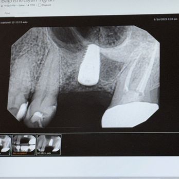 Elite Dental Group - They did an amazing job with my implant. - Cosmetic Dentists Near Me - Glendale, California Elite Dental Group - They did an amazing job with my implant. - Cosmetic Dentists Near Me - Glendale, California