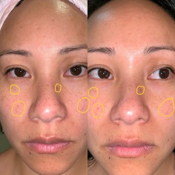 Beauty Unlimited - Left (Feb 23, 2019), Right (Apr 12, 2019) - Massage Near Me - Alameda, California Beauty Unlimited - Left (Feb 23, 2019), Right (Apr 12, 2019) - Massage Near Me - Alameda, California
