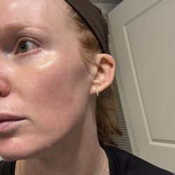 Medical Aesthetics on Tremont - After one Nano Laser treatment