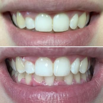 Nebu Sunless Tanning - Teeth Whitening - Spray Tanning Near Me