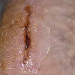 Palm Springs Podiatry - Healing of scar.