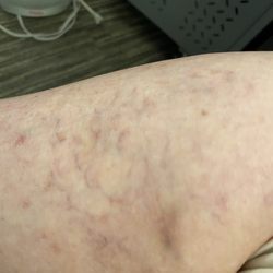 USA Vein Clinics - Photo after two months same area