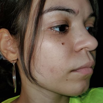 Calm Beauty Brooklyn - The Before. Very dull, lifeless... Stressed skin. Not cute. - Skin Care Near Me - Brooklyn, New York Calm Beauty Brooklyn - The Before. Very dull, lifeless... Stressed skin. Not cute. - Skin Care Near Me - Brooklyn, New York