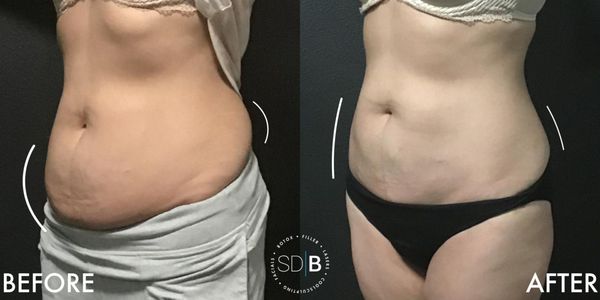 Coolsculpting - Coolsculpting is the #1 FDA approved body sculpting treatment. This technology uses cryolipolysis which freezes fat cells and naturally eliminates dead fat cells through your body’s own filtration system. This is a non-invasive, permanent therapy which can result in up to 20-25% reduction of stubborn fat with each session. Coolsculpting - Coolsculpting is the #1 FDA approved body sculpting treatment. This technology uses cryolipolysis which freezes fat cells and naturally eliminates dead fat cells through your body’s own filtration system. This is a non-invasive, permanent therapy which can result in up to 20-25% reduction of stubborn fat with each session.