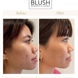 Blush Medspa & Laser - Microneedling - Before & After. Thermage, Morpheus8