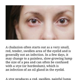 I guess he didn't study what a Chalazion is because after going to another doctor they have got me started on treatment to prevent this.