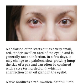 The Eyeglass Shop - I guess he didn't study what a Chalazion is because after going to another doctor they have got me started on treatment to prevent this. - Optometrists Near Me - San Antonio, Texas