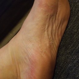 Had callus remover and this is my foot an hour after pedi. Had callus remover and this is my foot an hour after pedi.