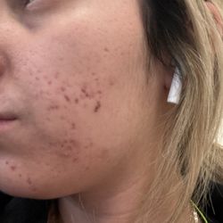 Berman Skin Institute - This was taken today 4/11/2024 no filter! Just my Camara roll zoomed in!