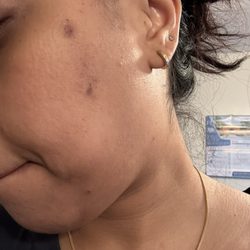 Radiance spa - Microdermabrasion after three days