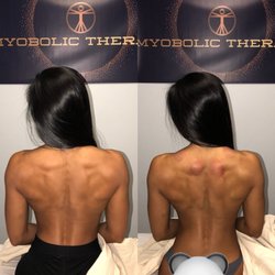 Myobolic Therapy - Before & After Josh's Work of Deep Tissue & Cupping