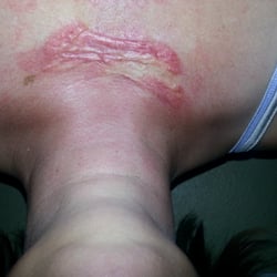 Shwol-Huo Kiang DO - After second set of injections