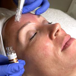 Victorious Skincare - Microneedling